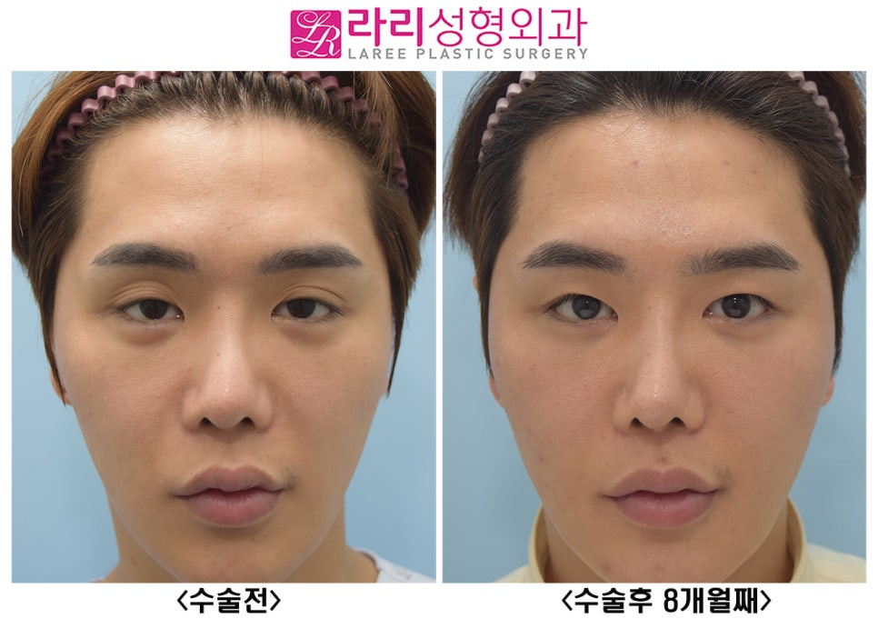 [라리성형외과] 여러겹 두꺼운 자연 쌍꺼풀 무쌍으로 풀기, 없애는 수술 관련 이미지 1