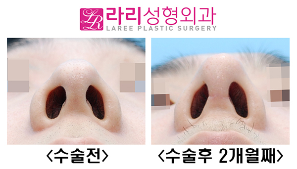 [Lari Plastic Surgery] Hump Nose Surgery Without an Implant image 4