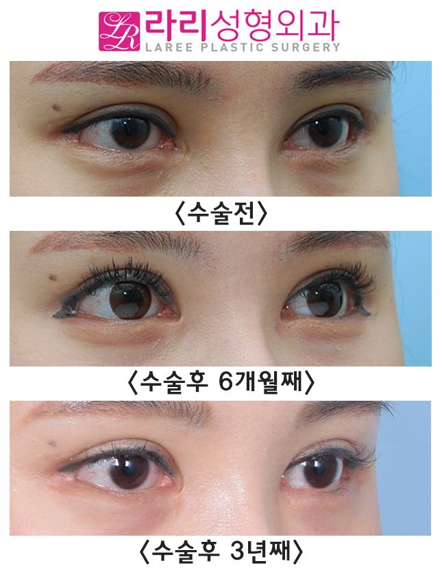 [Laree Plastic Surgery] Before-and-After Photos of Long-Term Follow-Up After Medial Epicanthoplasty Revision, Following Short-Term Follow-Up image 3
