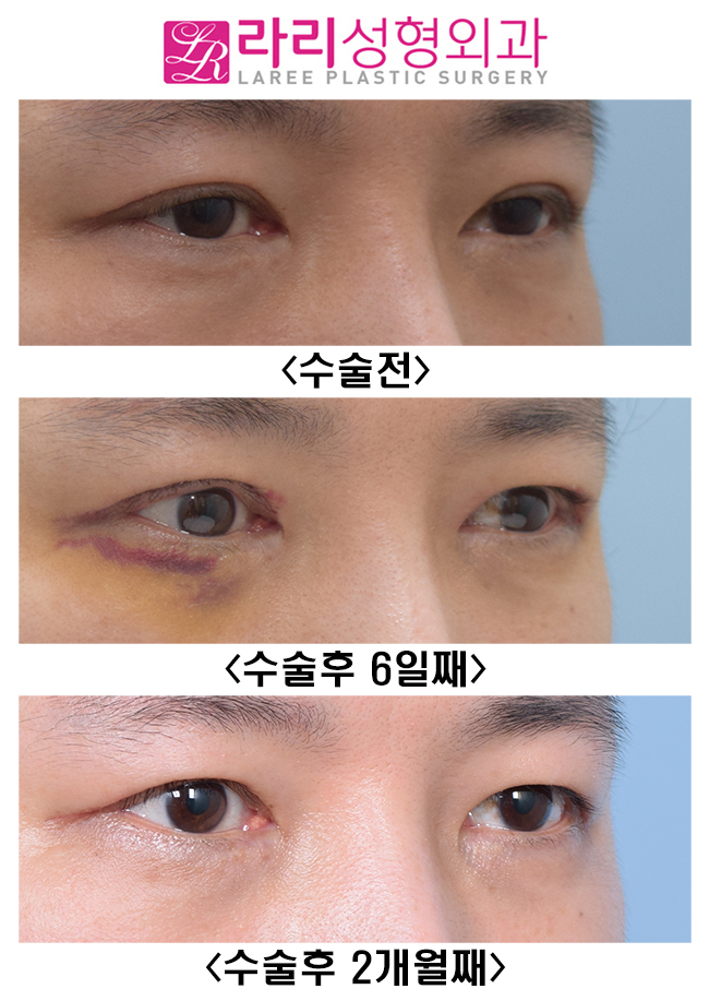 [라리성형외과] 쌍꺼풀없애기 수술 후 짝짝이, 괜찮아질까? 관련 이미지 5