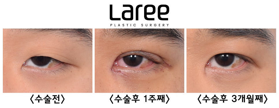 [Rari Plastic Surgery] After Eye Surgery, Is Mucosal Show Normal?! image 3