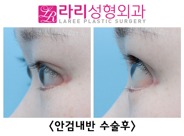 [Lari Plastic Surgery] Lower blepharoplasty including entropion correction, the most common cause of iatrogenic ectropion image 2