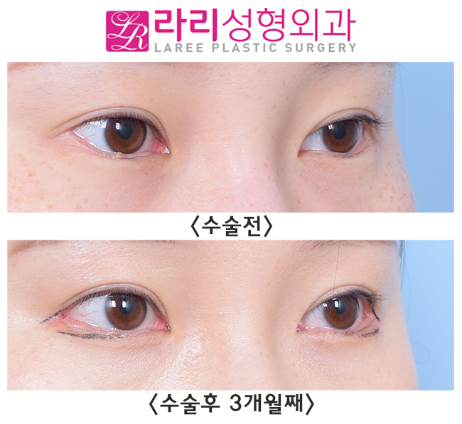 [라리성형외과] 눈꼬리내리기뒤트임효과 확실히 보는 눈 관련 이미지 3