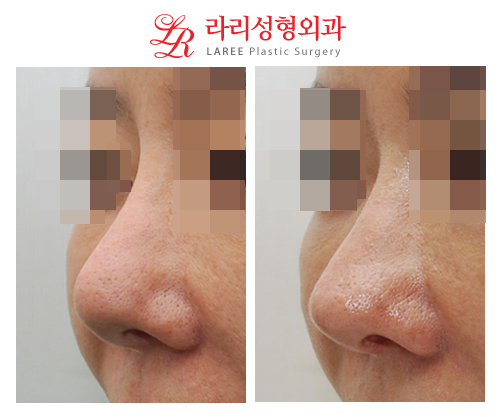 Before-and-After Photos of Revision Rhinoplasty for a Bulky, Upturned Nose-☆ image 2