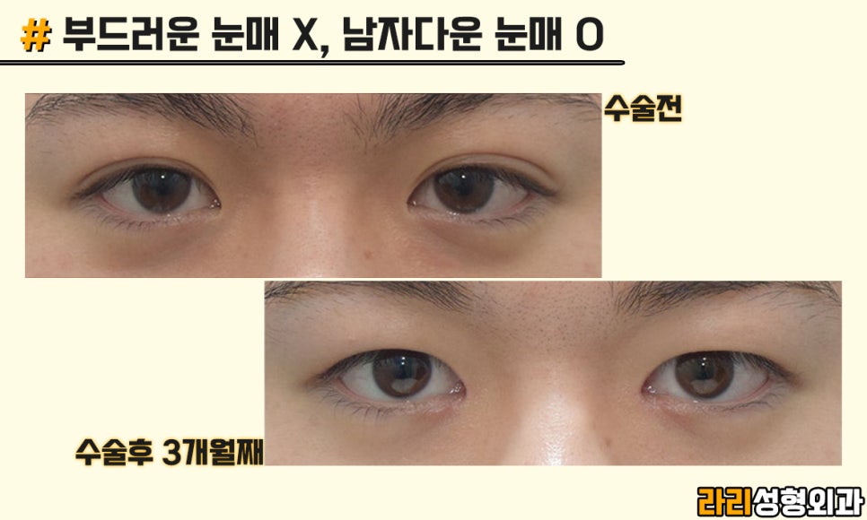 [Lari Plastic Surgery] Men’s Eye Surgery, Trends and Desired Look - Monolid & Hidden Double Eyelid image 8