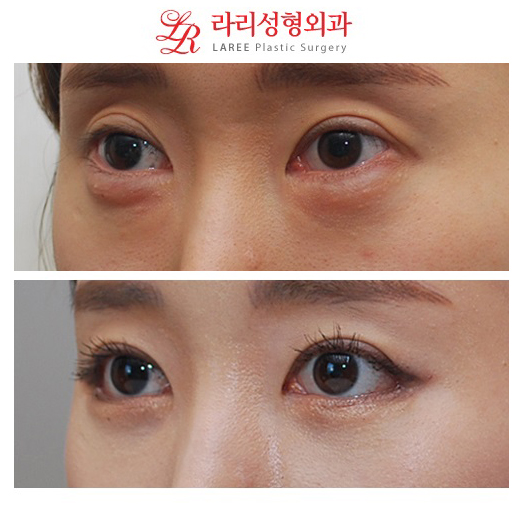 [Big-Eyed Canthoplasty] Revision Surgery for Lateral Canthoplasty to Lower the Outer Eye Corner / Revision Surgery for Lowering the Outer Eye Corner, Before-and-After Photos of Under-Eye Fat Repositioning image 4