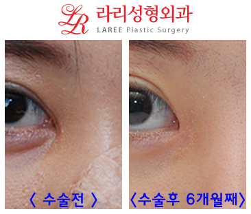 앞트임흉터제거 및 앞트임복원/앞트임재건의 효과를 알아보자! 관련 이미지 6