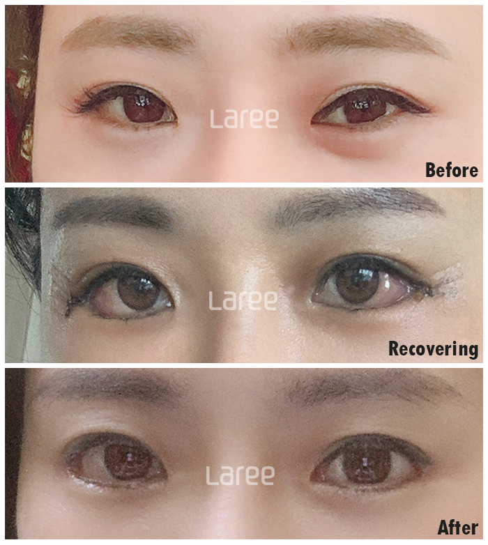 [라리성형외과] 탁 트인 눈을 위한 뒤트임 수술 전 알아야 할 핵심 키워드 완전정복 관련 이미지 3