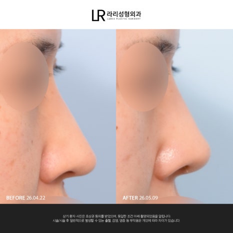 [Lari Plastic Surgery] If You Are Considering Nose Surgery, Do Not Get Nose Thread-Lifting Procedures Like Misko / Hiko!! image 14