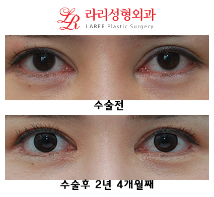 Total Eye Plastic Surgery Care (Ptosis Revision Surgery, Epicanthoplasty Restoration, Revision Lateral Canthoplasty) image 1