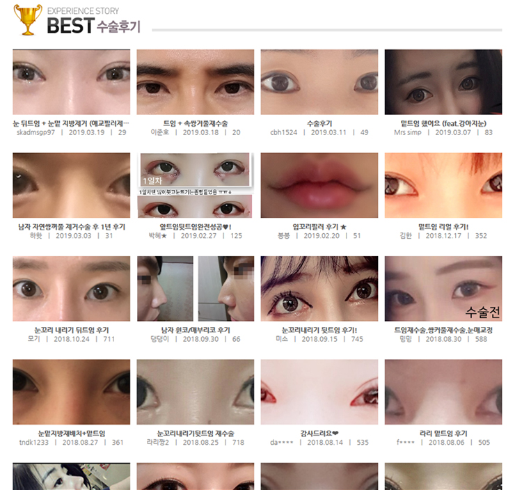Before-and-After Photos of Epicanthoplasty / Canthoplasty image 5