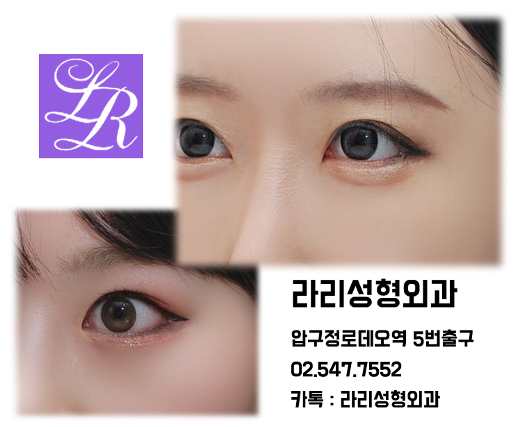 Double Eyelid Surgery, Eye Plastic Surgery: Questions About Washing Hair and Eye Makeup image 5