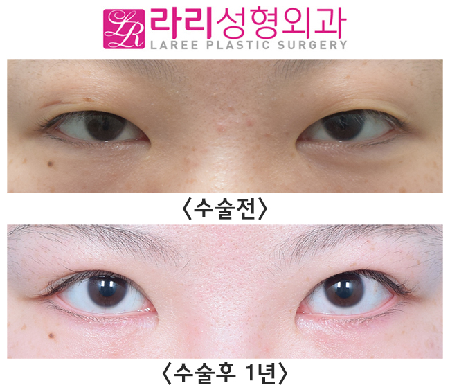 [라리성형외과] 절개눈매교정 자연스러운 인라인 속쌍 + 눈꺼풀 패인 흉터교정 관련 이미지 1