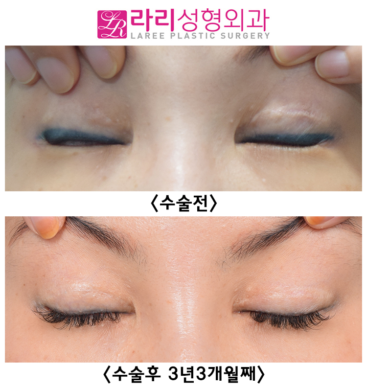[라리성형외과] 여러 번 반복하지 않아도 되는 두꺼운 아이라인 문신 축소수술 전후 비교 관련 이미지 3