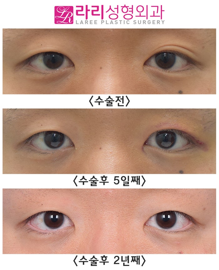 [Lari Plastic Surgery] Double Eyelid Removal: Long-Term Before-and-After Photos of Surgery on Only One Side image 3
