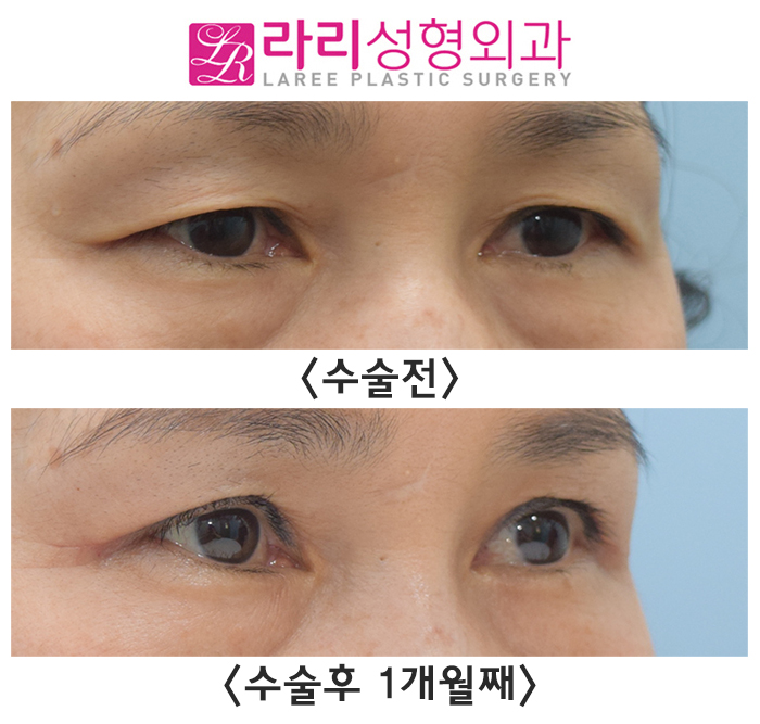 [라리성형외과] 처진 피부에 가려진 내 큰 눈 찾아주는 상안검수술 전후 사진 관련 이미지 1