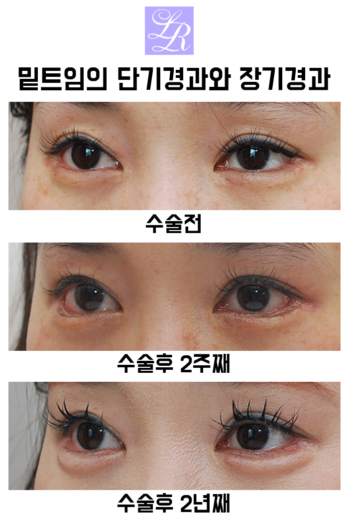 If You Want an S-Line Under Your Eyes, Try Lower Eye Widening image 14