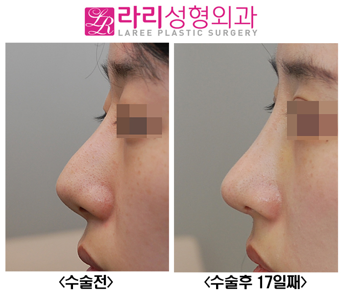[라리성형외과] 꺾인 콧대 낮은 코끝 살리는 코재수술 관련 이미지 5
