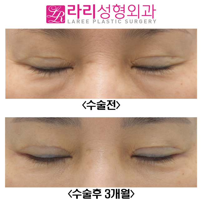 [Lari Plastic Surgery] Before-and-After Photos of Correcting Sausage-like Double Eyelids with Revision Double Eyelid Surgery image 5
