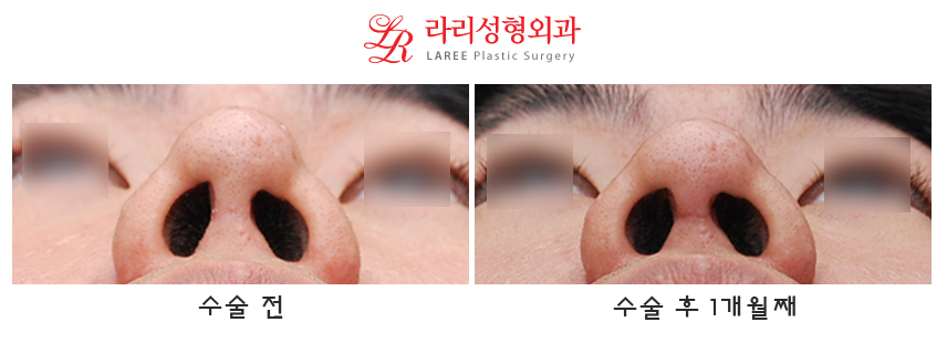 Correction of Upturned Nose and Contracted Nose, Revision Rhinoplasty Using Autologous Tissue (feat. Ear Cartilage) image 3