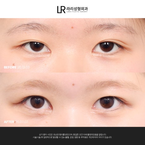 [라리성형외과] 쌍꺼풀수술 전후 사진으로 보는 눈매교정의 중요성 관련 이미지 8