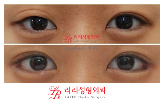 뒤트임/뒷트임 사진 후기 정보☆ 관련 이미지 6