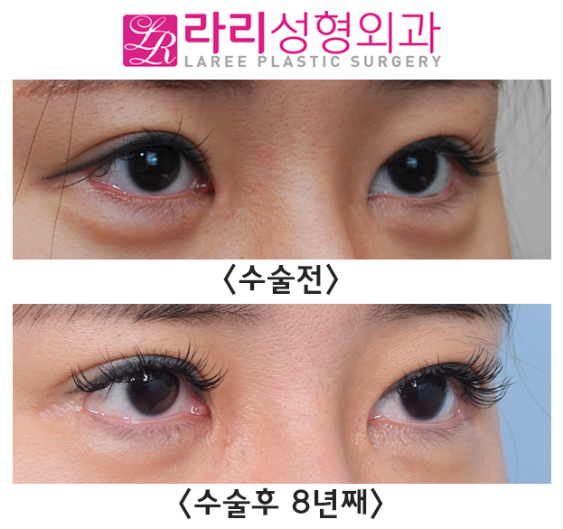 [Lari Plastic Surgery] Canthoplasty Reoperation for Lowering the Outer Corner of the Eyes: Before-and-After Photos Over More Than 8 Years of Long-Term Follow-Up image 3