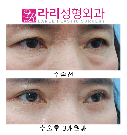 (Middle-aged) Upper Eyelid Surgery and Lower Eyelid Surgery at the Same Time image 3