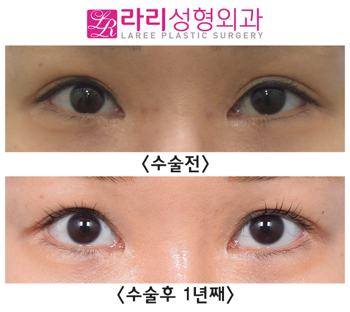 [라리성형외과] 수술 티 나지 않는 자연스러운 밑트임수술 전후 사진 관련 이미지 1