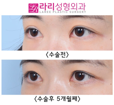 [Lari Plastic Surgery] Lowering the Double Eyelid Line to Near Single Eyelid Level: Before-and-After Photos of a Low Crease Revision image 3