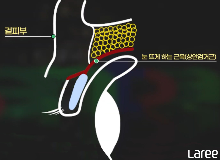 [라리성형외과] 쌍꺼풀수술 후 쌍꺼풀이 풀리는 이유 관련 이미지 9
