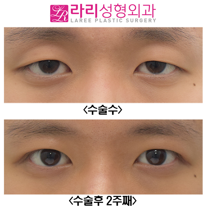 [Lari Plastic Surgery] Full Non-Incision Eye Correction, Effects and Before-and-After Photos (Different from Double Eyelid Surgery) image 7
