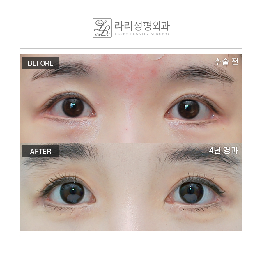 [라리성형외과] 밑트임수술 3년 이상 장기경과 전후사진 관련 이미지 1