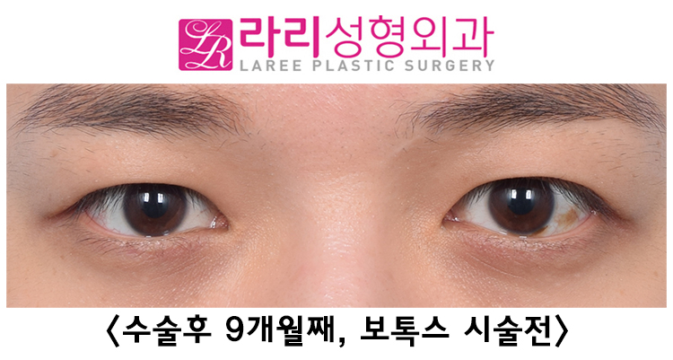 [Lari Plastic Surgery] Correcting Uneven Eyes with Forehead Botox After Double Eyelid Removal Surgery image 3