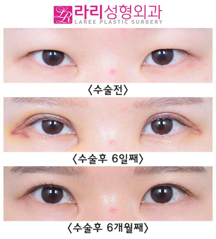 [Lari Plastic Surgery] Incisional Eye Correction Surgery for a Hidden Double Eyelid in a Monolid: Swelling Period Before and After (+Selfie) image 4
