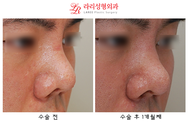 Correction of Upturned Nose and Contracted Nose, Revision Rhinoplasty Using Autologous Tissue (feat. Ear Cartilage) image 6