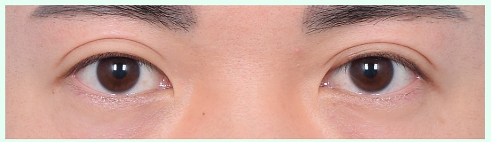 [Lari Plastic Surgery] Removing a Visible Double Eyelid (Double Eyelid Reversal Surgery), From Natural Double Eyelids to Surgical Double Eyelids: A to Z image 8
