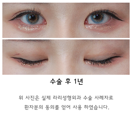 Swelling and Results Judged from Photos in Non-Incision Eye Correction Reviews image 7