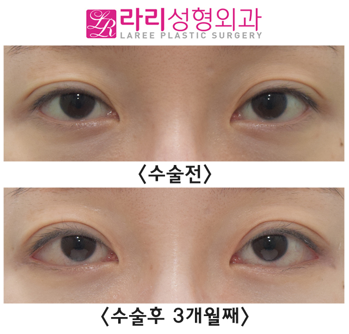 [라리성형외과] 수술 직후부터 흉터까지 뒤트임재수술 후 경과와 증상들 알아보기. 관련 이미지 1