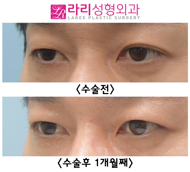 [라리성형외과] 쌍커풀 없애는 수술 후 회복이 빠른 경우 전후 사진 관련 이미지 4
