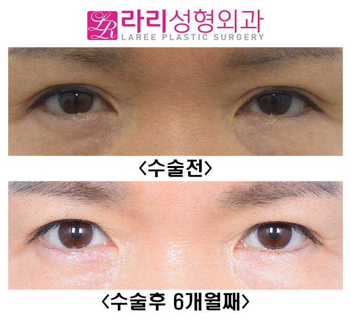 [라리성형외과] 여자도 쌍꺼풀없애기 - 함몰눈에 어울리는 눈 관련 이미지 1