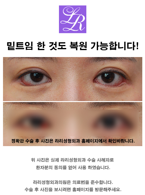 눈 밑트임 한것도 복원이 가능한가요? 관련 이미지 2