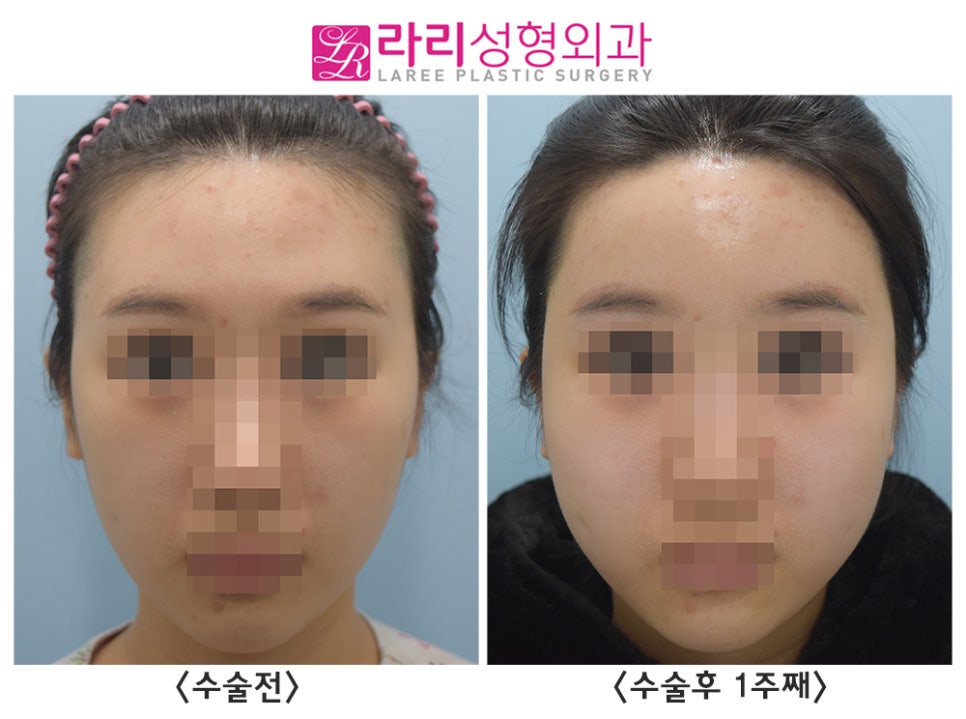 [Rari Plastic Surgery] Facial Fat Grafting (Forehead, Cheeks) Before-and-After Photos: 1-Week Progress image 3