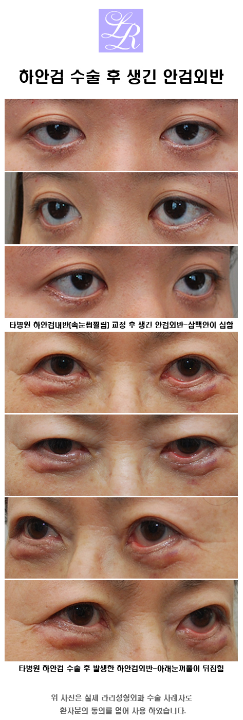 Will lower eye corner surgery or lower blepharoplasty side effects cause ectropion? image 3