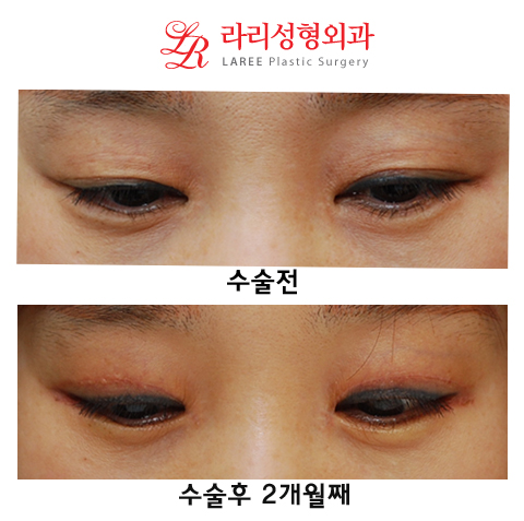 Revision Eyelid Surgery, Cases That Need Ptosis Correction, Correcting Asymmetry in Uneven Eyes image 6