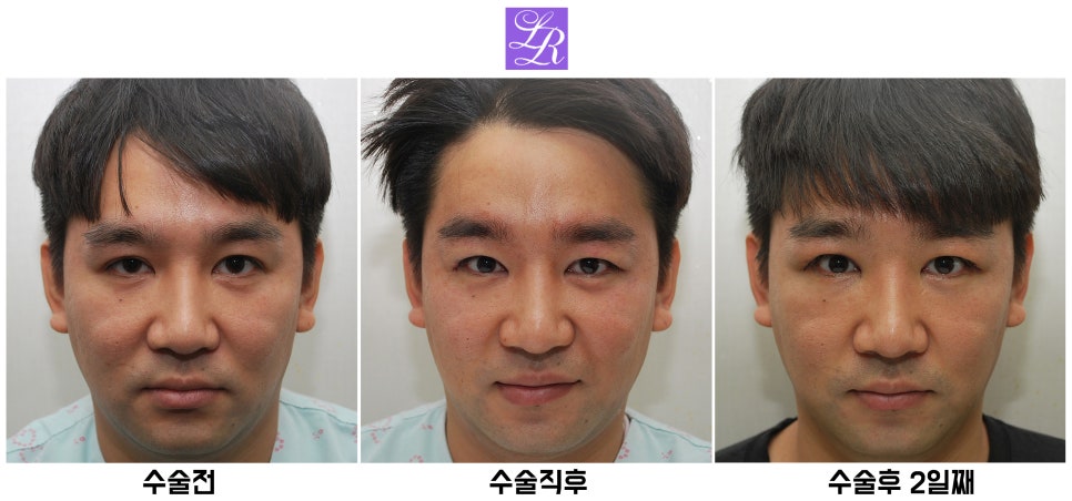 Review of Double Eyelid Reversal Surgery - Day 2 After Surgery, Swelling After Double Eyelid Surgery image 1