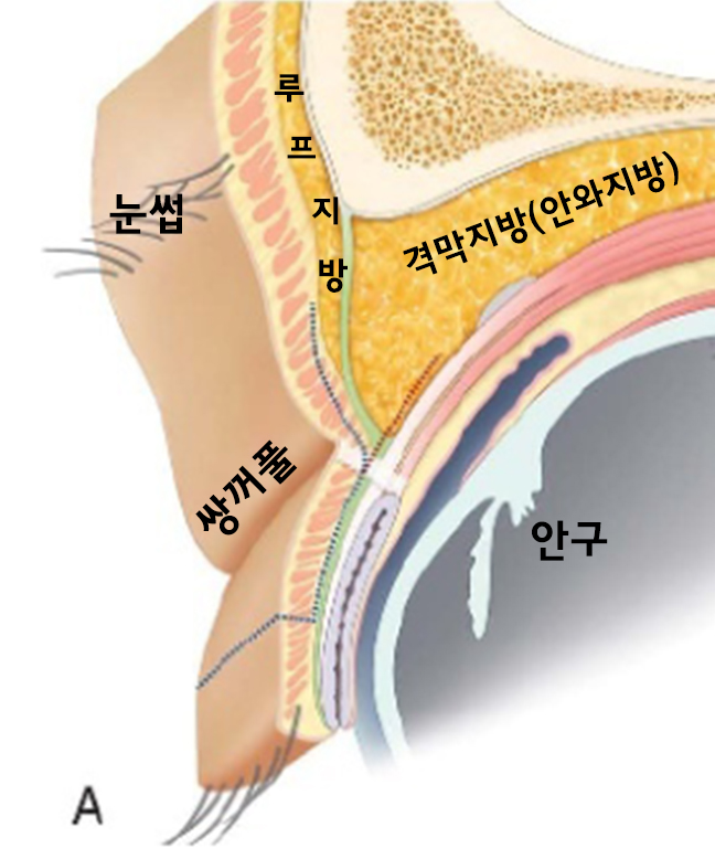 [라리성형외과] 쌍꺼풀없애기 수술 눈안감김(토안)의 원인이 정말 피부절제 때문일까? - 무절제쌍꺼풀없애기 관련 이미지 2