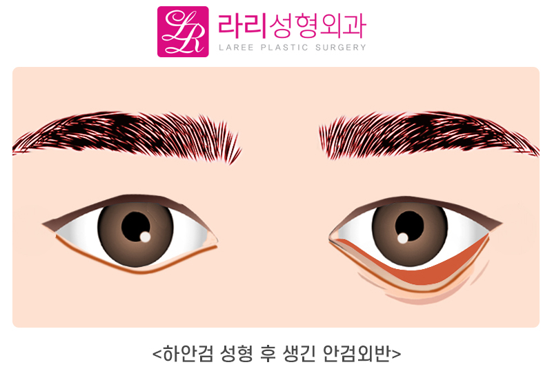 [Lari Plastic Surgery] What Is Ectropion? The Definition and Causes of Ectropion image 2
