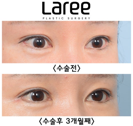 [Lari Plastic Surgery] A Collection of Various Surgeries for Double Eyelids image 6