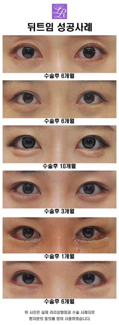 Revision Lateral Canthoplasty: Short-Term, Mid-Term, and Long-Term Progress (feat. Lari) image 5